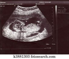 Sonogram of the baby