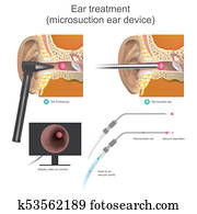 The Micro suction ear device it is vacuum working system. Doctors use air vacuum pump to suction the ball shape inside ear canal. Illustration. The Micro suction ear device it is vacuum working system. Doctors use air vacuum pump to suction the ball shape inside ear canal. Illustration.