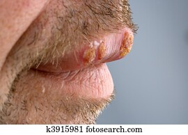 Herpes - cold sore Herpes - cold sore