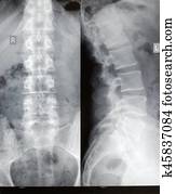 Spinal xray Spinal xray