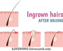 structure of the hair follicle structure of the hair follicle