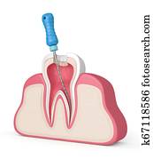3d render of tooth with endodontic file in gums 3d render of tooth with endodontic file in gums