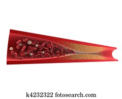 動脈硬化 イラストレーション 236 動脈硬化 ストックアート Fotosearch 動脈硬化 イラストレーション 236 動脈硬化 ストックアート Fotosearch