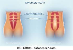 diastasis, ראכטי, או, בטני, הפרדה