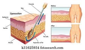 liposuction