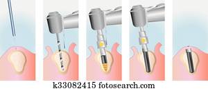 IMPLANT SURGERY IMPLANT SURGERY