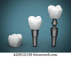 dental, implants