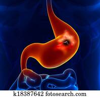 Stomach Cancer Stomach Cancer