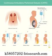 נמשך, ambulatory, פאריטונאיל, דיאליזה, capd