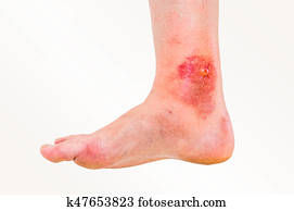 vermelho, erupção, ligado, perna, de, paciente, quem, era, mordido, por, um, inseto