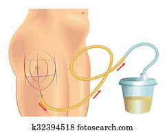 liposuction liposuction