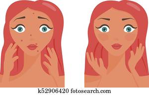 cartaz, de, acne, pimples.