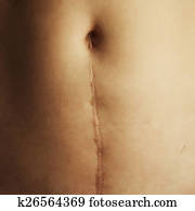 close up scar on skin close up scar on skin