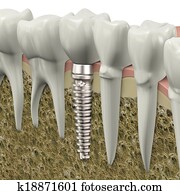 Dental implant Dental implant