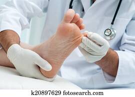 Tinia pedis or Athletes foot