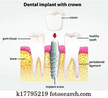 של השיניים, השרש, עם, הכתר