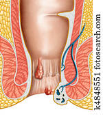 Hemorrhoids Hemorrhoids