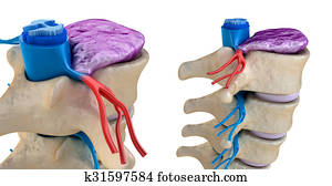 Spinal cord under pressure of bulging disc Spinal cord under pressure of bulging disc