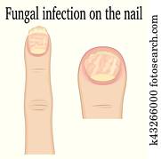Nail fungal infection Nail fungal infection
