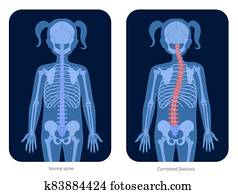 עמוד שדרה, *x* קרן
