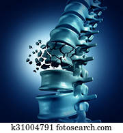 Spinal Fracture Spinal Fracture