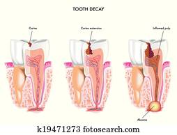 tooth decay tooth decay