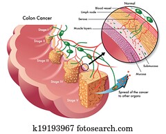 סרטן של קולון