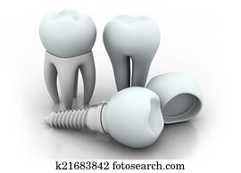 Dental Implant Dental Implant