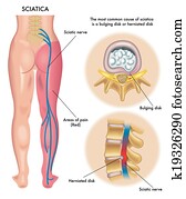 sciatica sciatica
