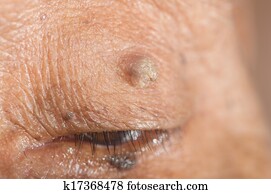 skin tag on eyelash line