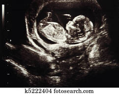 Ultrasound pregnancy Ultrasound pregnancy