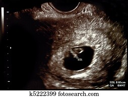 Ultrasound pregnancy Ultrasound pregnancy