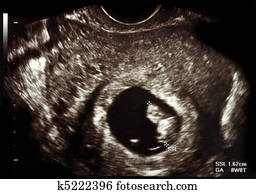 Ultrasound pregnancy Ultrasound pregnancy