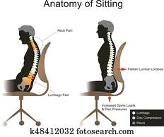 sciatica., gesundheitspflege, info, grafik, vector.