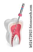 3d render of tooth with endodontic file 3d render of tooth with endodontic file
