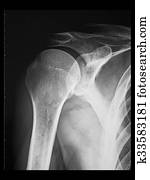 ombro, X-ray., Male.