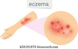 A Vector of Eczema on Skin A Vector of Eczema on Skin