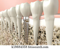 dental, implante