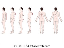 עיוות, של, ה, spine?