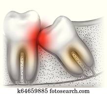 Wisdom tooth eruption problems Wisdom tooth eruption problems