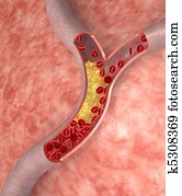 Cholesterol in artery