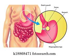 vertical banded gastroplasty vertical banded gastroplasty
