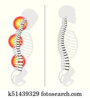 Slipped Disc Prolapse Back Pain Spine Slipped Disc Prolapse Back Pain Spine