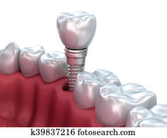 Dental implant, Medically accurate 3D illustration Dental implant, Medically accurate 3D illustration
