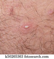 Ingrown Hair Closeup Stock Photography K50296145 Fotosearch