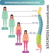 tetraplegia, ו, פאראפלאגיה, של השדרה, עצבי, אי סדר, רפואי, וקטור, דוגמה, תרשים, עם, נקבה, חולה, ו, השקע בעצם, חתך לרוחב, scheme.