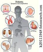 סוכרת, (symptoms, ו, סיבוך