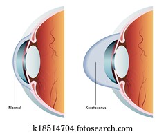 keratoconus keratoconus