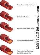 Atherosclerosis Atherosclerosis