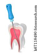 3d render of tooth with endodontic file 3d render of tooth with endodontic file